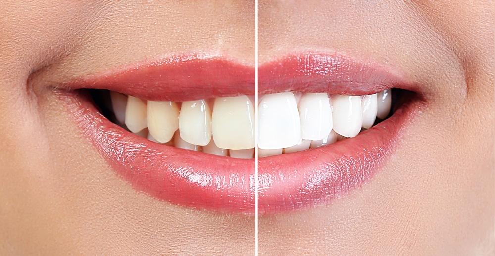 Teeth Whitening