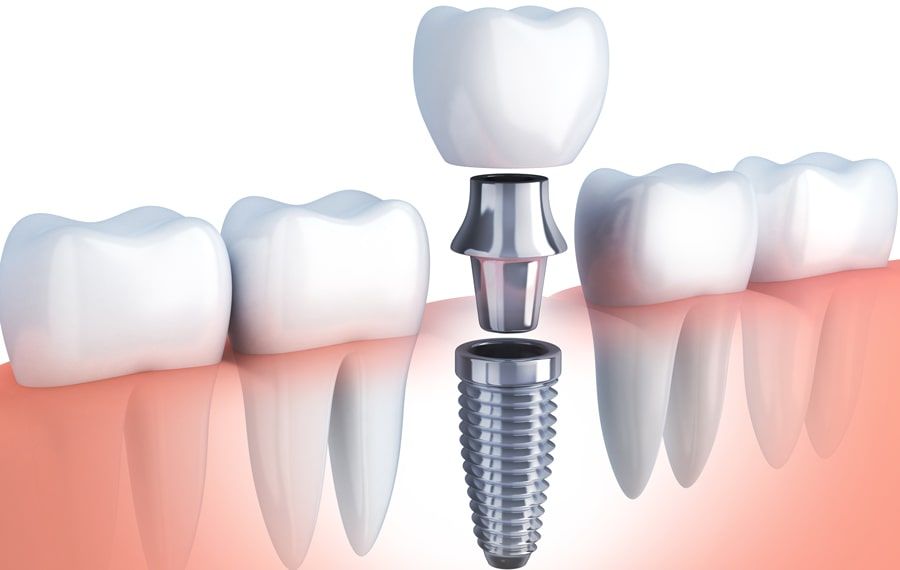 implant