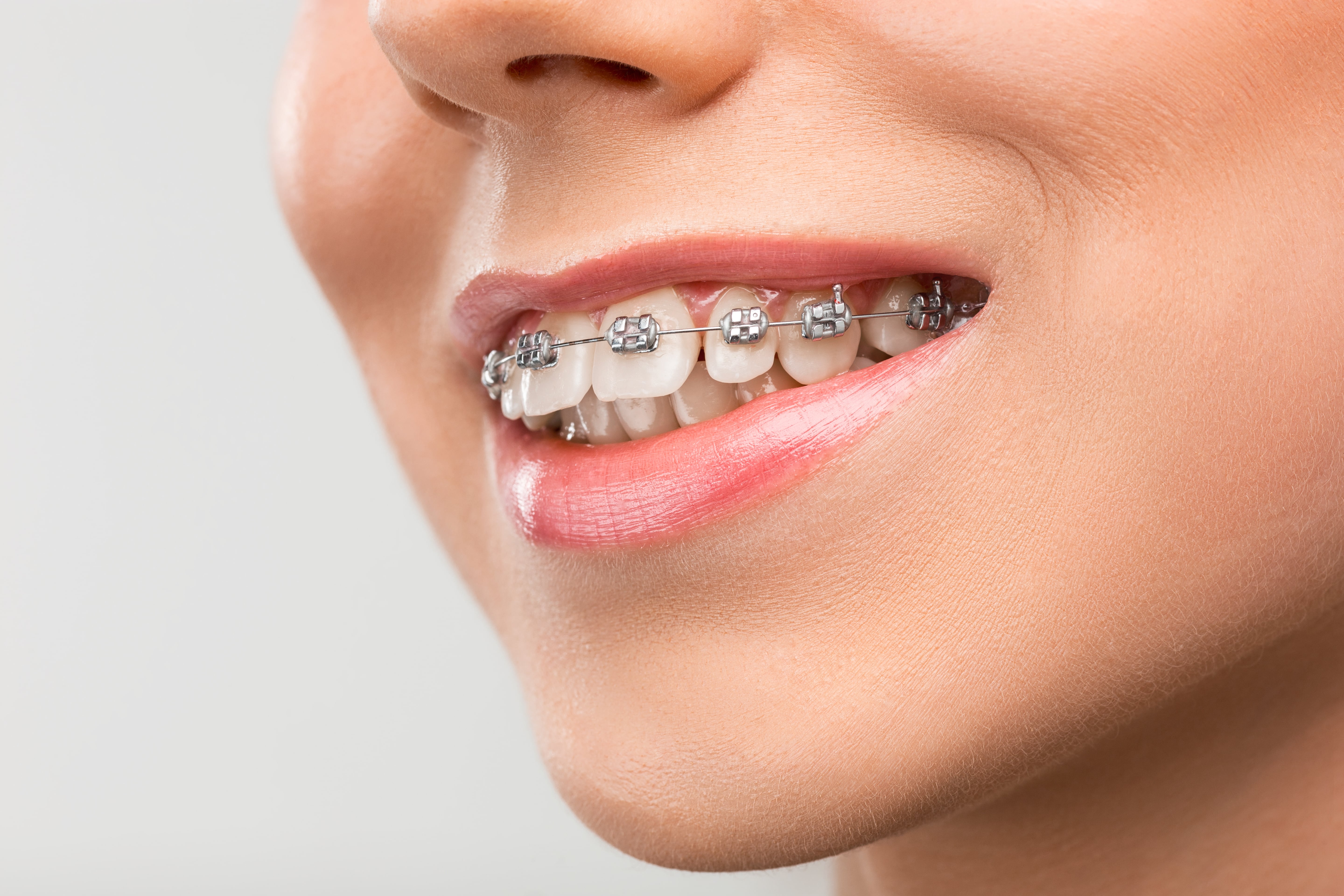 Orthodontic Dental Braces